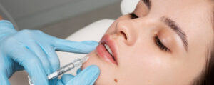 contorno labial harmonização facial